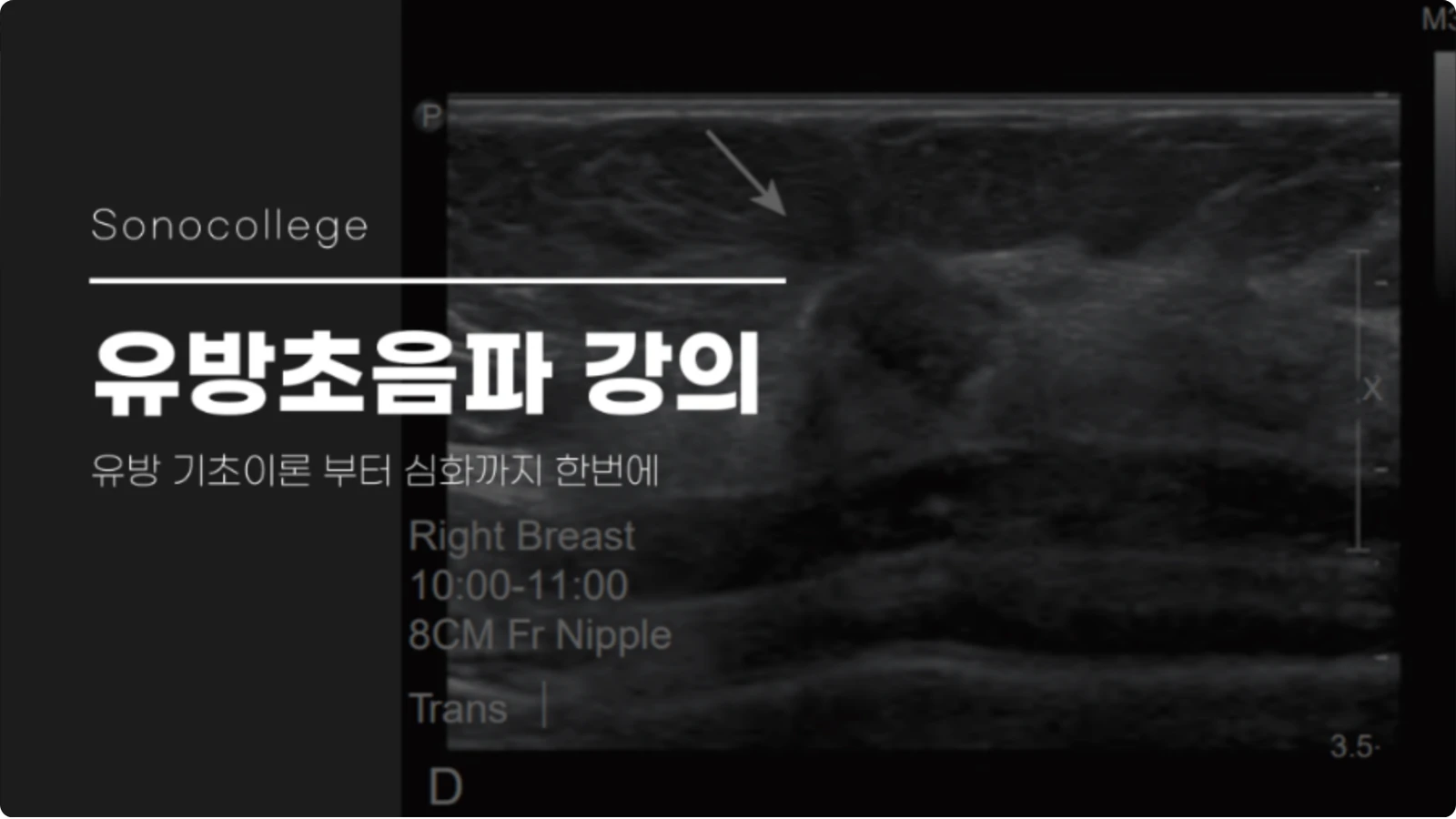 유방 초음파 강의 썸네일